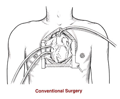 Conventional Heart surgery